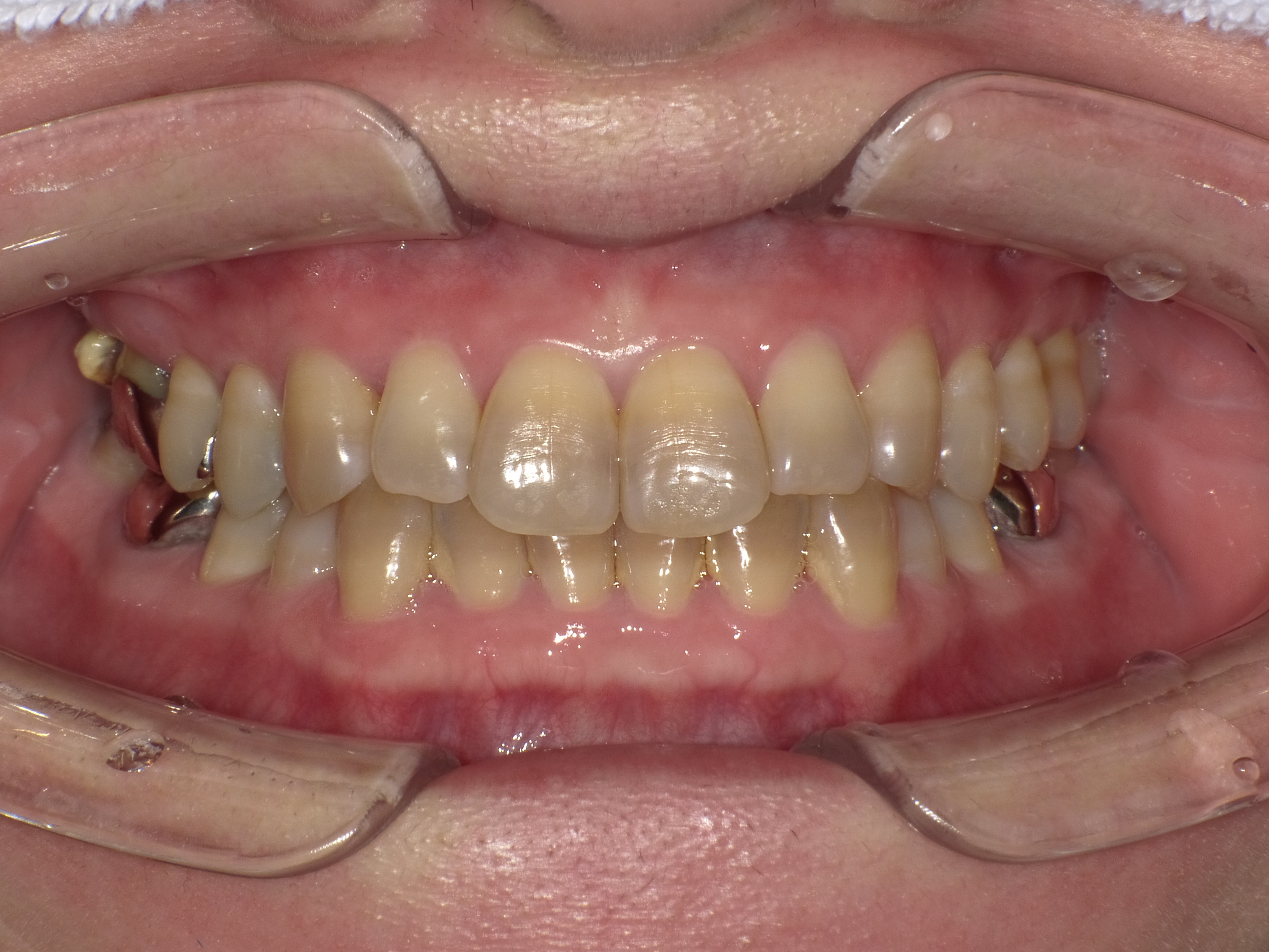 Before