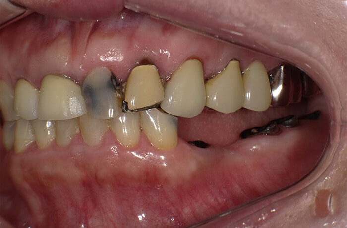 前歯の審美セラミック治療 Before